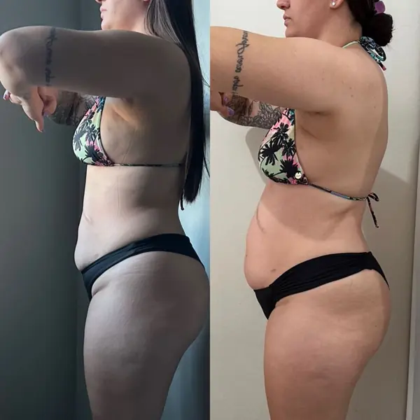 Antes e depois da aluna Samanta Santos mostrando redução de barriga em uma semana.
